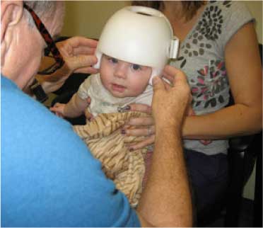 Infant Wearing Cranial Molding Helmet